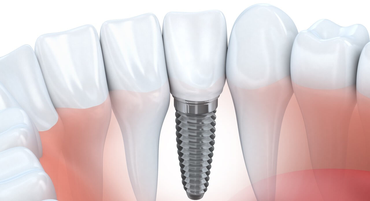 Implantes dentales centro de Toluca